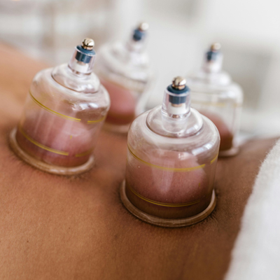 A patient getting a cupping session from Healing Cornerstone, the best naturopathic doctor in Charleston, SC