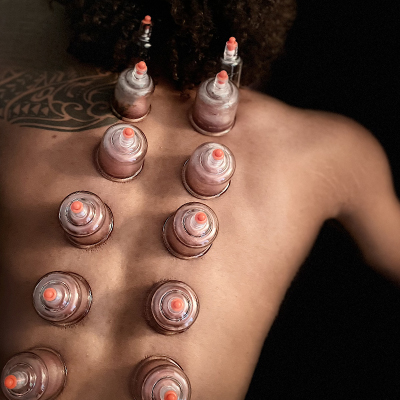 A patient getting a cupping session from Healing Cornerstone, the best naturopathic doctor in Charleston, SC