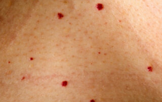 Angiomas on the Body needing Holistic removal