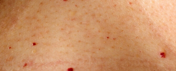 Angiomas on the Body needing Holistic removal